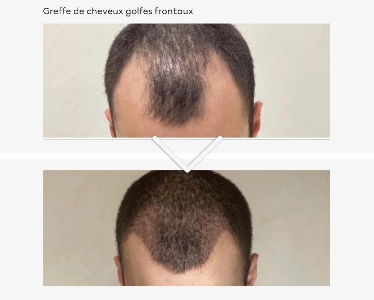 Bordeaux Greffe de cheveux (Implants capillaires) — free download